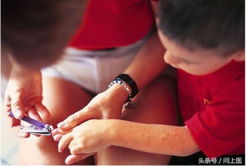 改善宝宝湿疹的物理方法,改善湿疹的图片