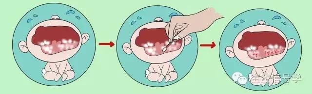 宝宝嘴巴有一层黄黄黏膜是什么,宝宝嘴里有黏黏的东西