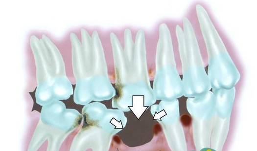 牙科镶牙全过程,口腔科普镶牙全过程图