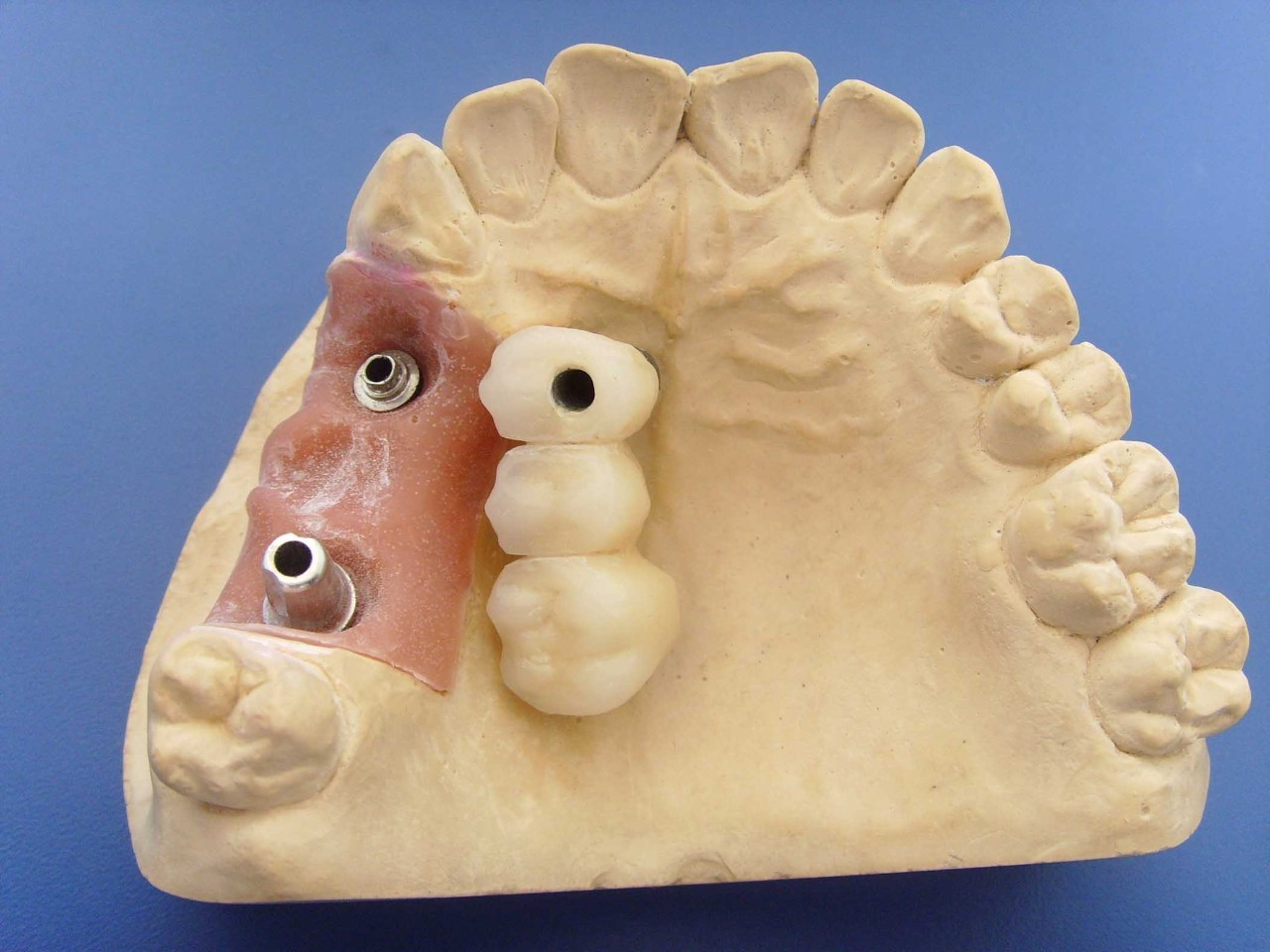 牙科镶牙全过程,口腔科普镶牙全过程图