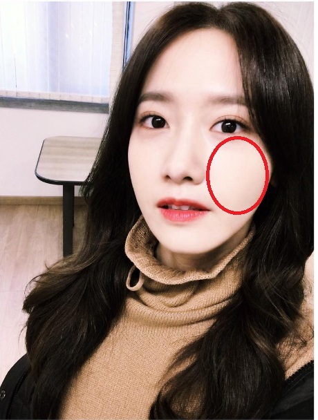 脸部不同部位痘痘代表什么,不同的痘痘要用不同的方法处理