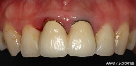 装了烤瓷牙真的是一条不归路吗,烤瓷牙做了后悔一辈子