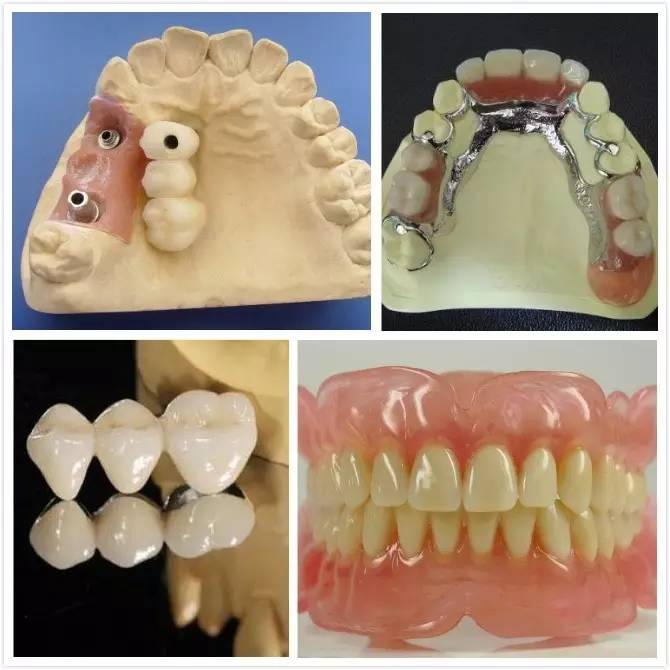 牙科镶牙全过程,口腔科普镶牙全过程图