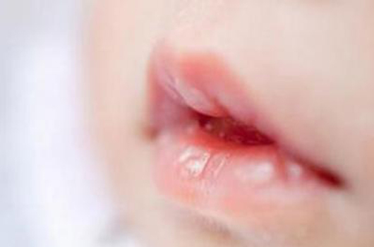 为什么宝宝会得败血症,因为妈妈的疏忽导致婴儿受伤