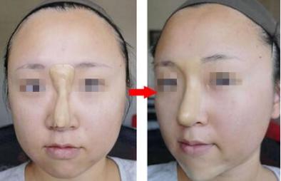 痱子粉也能隆鼻啊？看完给跪了