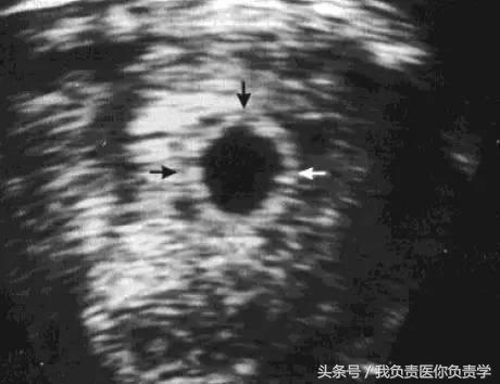 早孕彩超未见胚芽,早孕彩超无回声
