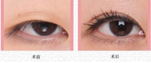 韩式三点双眼皮和埋线哪个创伤大,韩式三点双眼皮手术前注意事项