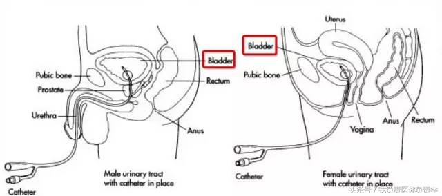尿道括约肌松弛尿失禁的处理方法,括约肌松弛会尿不尽吗