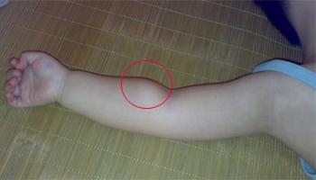 身上长脂肪瘤要不要割掉,身上长了脂肪瘤需要切除吗