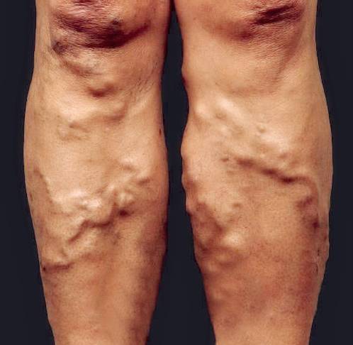 蚯蚓爬到地面上怎么回事,蚯蚓腿凸出来怎么治疗效果最好