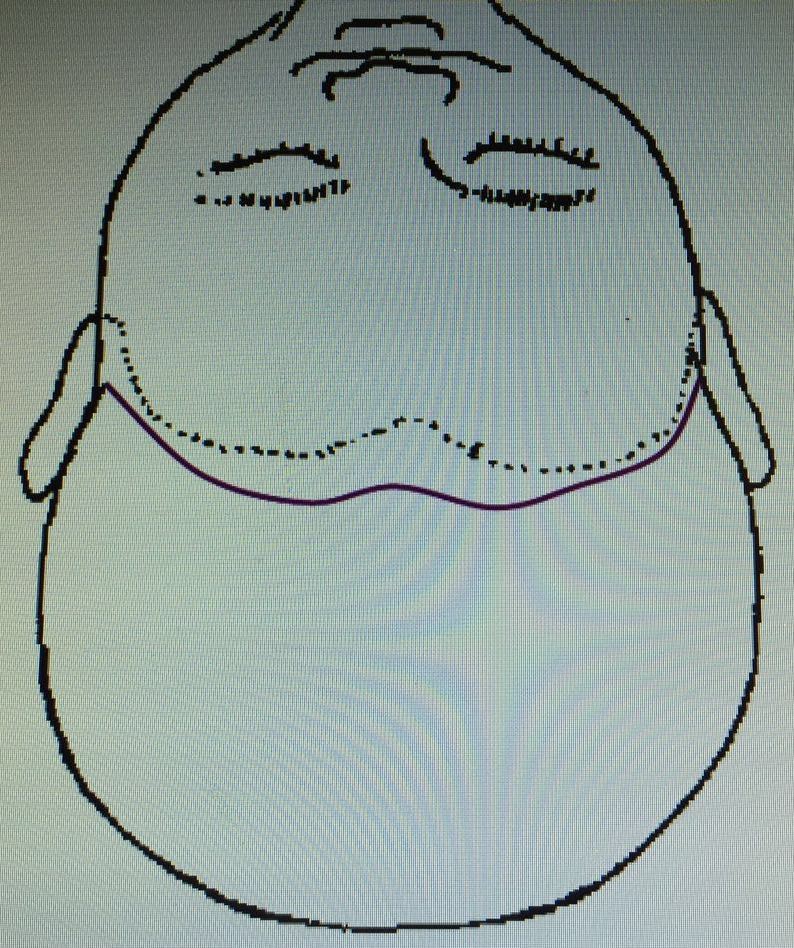 手术治疗颅咽管瘤相关问题