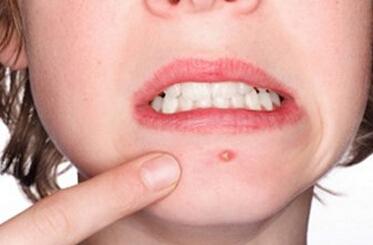 后背起包后挤出脓液怎么回事,后背长了个包硬硬的是怎么回事