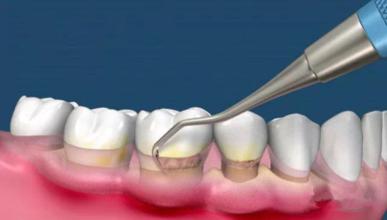 每个人都有尖尖牙吗,每个人都有牙隐纹吗