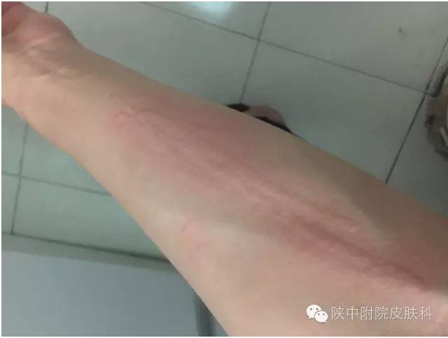 关于荨麻疹的三个常见误区,皮肤过敏荨麻疹的症状和治疗方法