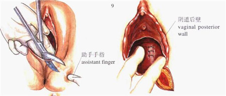 顺产侧切38天伤口疼正常吗,顺产妈妈肚子疼正常吗