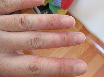 手上湿疹起水泡痒怎么办,手上长湿疹有小水泡小妙招