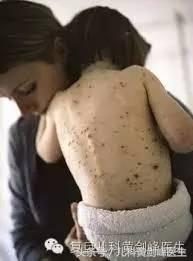 得了水痘莫惊慌,水痘高峰期如何通知家长预防