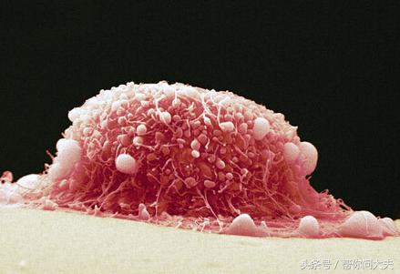 社区宫颈癌筛查和医院筛查的区别,一年前宫颈癌筛查一年后会变癌吗