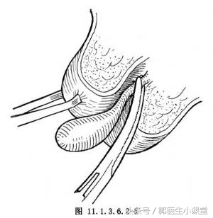 宫颈息肉要不要切除会不会变癌,怀孕宫颈息肉会流浅红色分泌物
