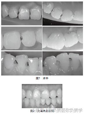 口腔疾病防治的方法,口腔龋病