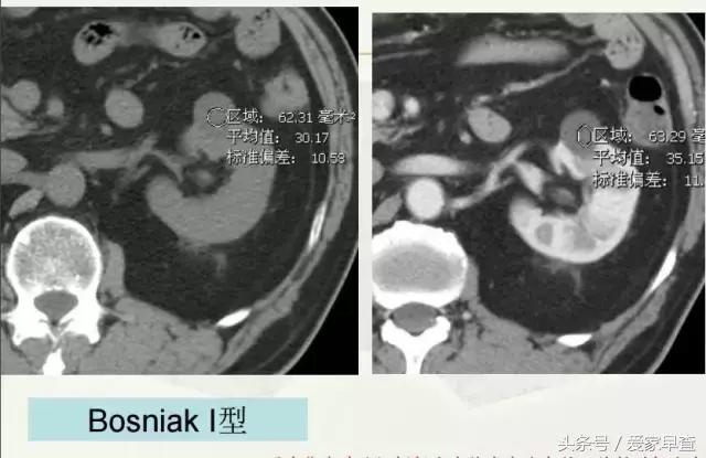 布什还是奥巴马?放射科杨大夫谈体检查出的结节和囊肿
