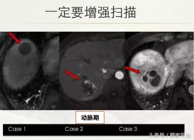 布什还是奥巴马?放射科杨大夫谈体检查出的结节和囊肿