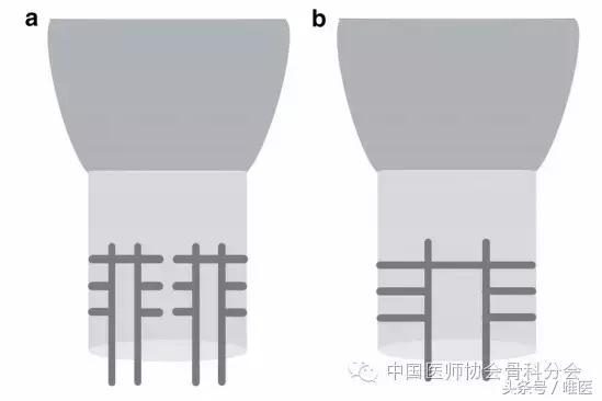 跟腱断裂eras快速康复,跟腱断裂用什么不可吸收线缝合