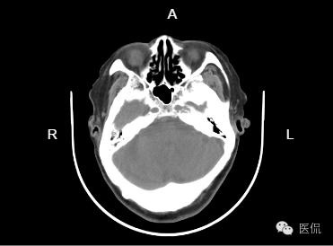专家讲解脑白质疏松症,脑部核磁显示轻度脑白质疏松