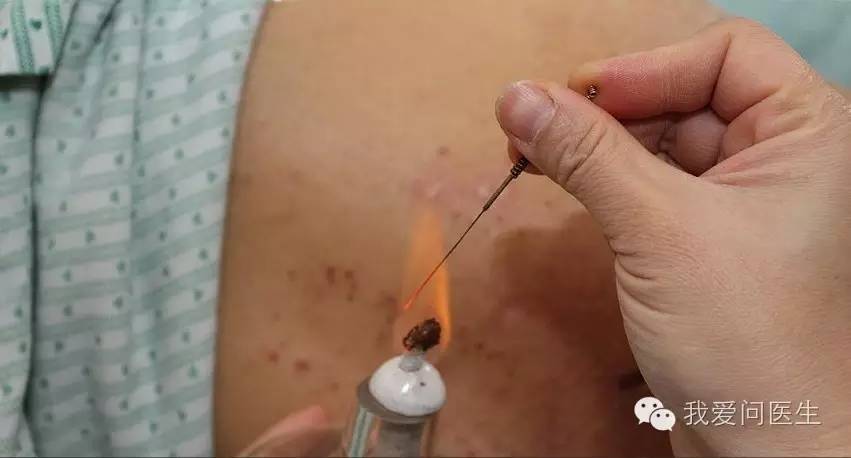 院长直播北京中医医院应对雾霾设顽咳专病门诊