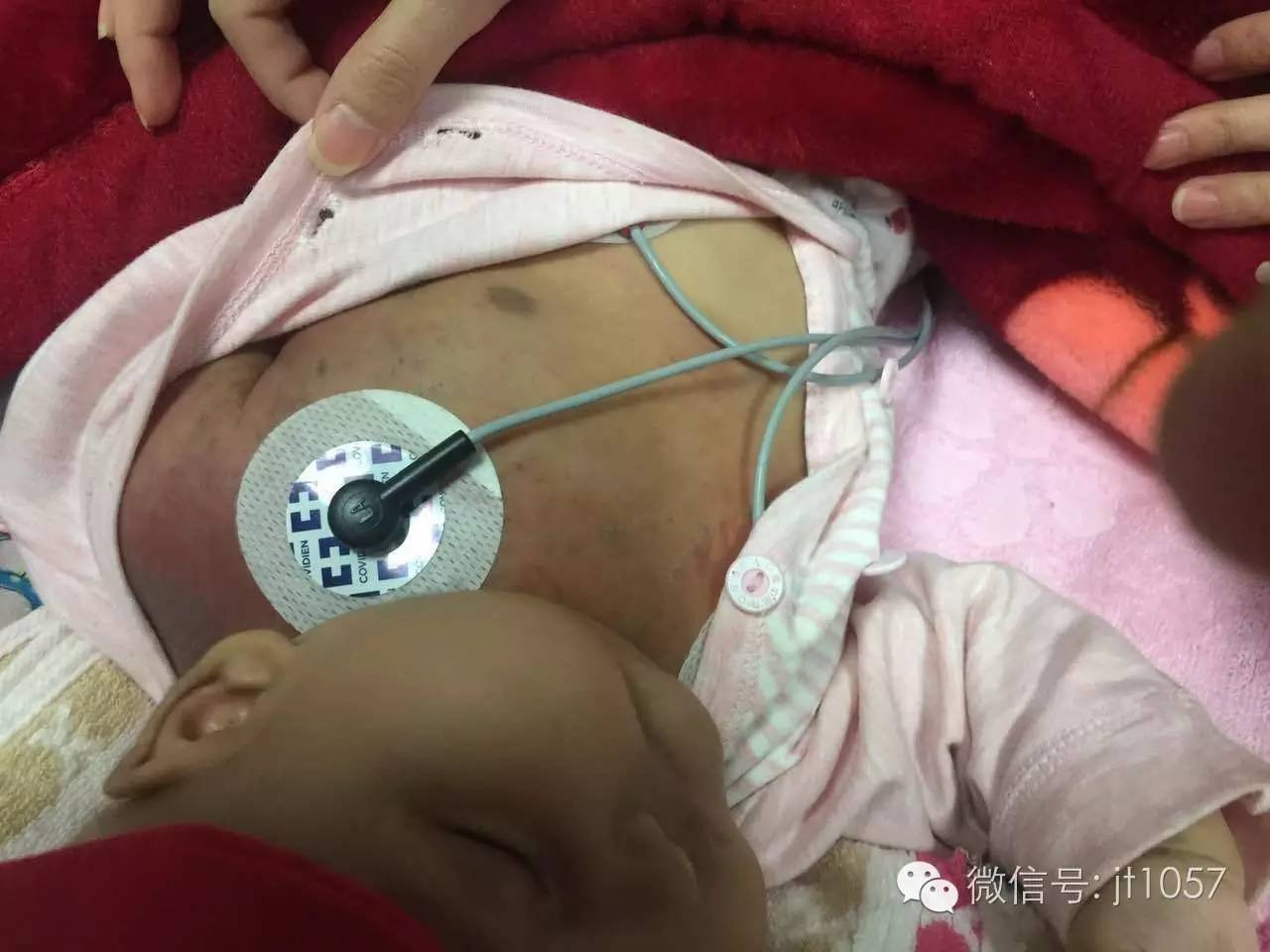 女婴出生26天得罕见病,维吾尔族女婴