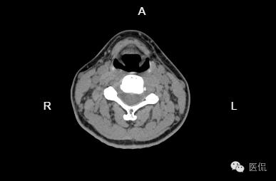 颈椎病例报告,专家诊断脂肪肝