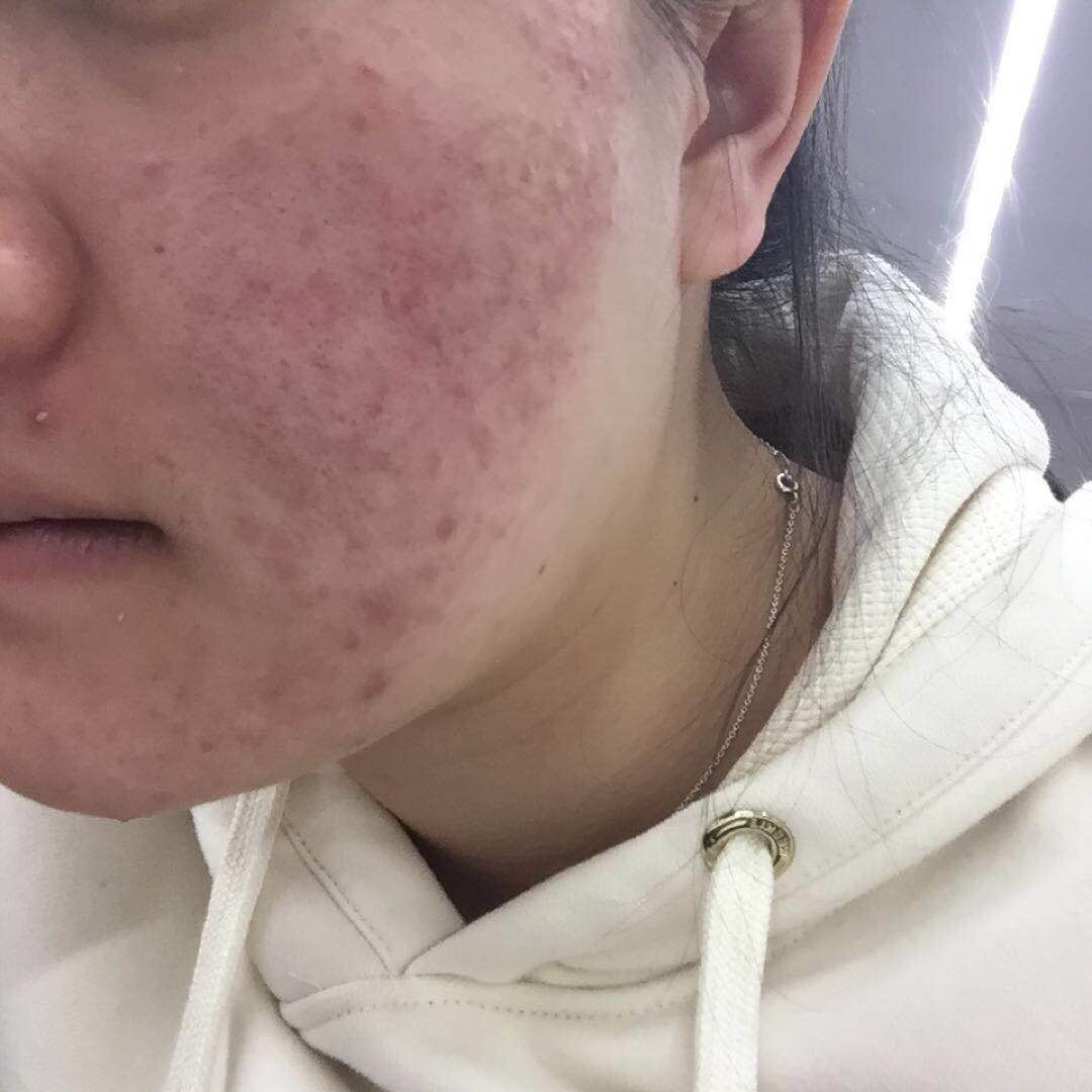 杭州大四女生两年花七万治痘,杭州大四女生视频