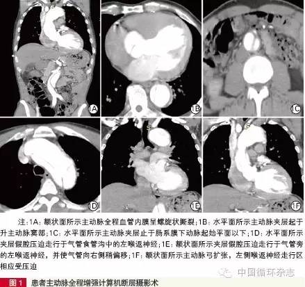 患者声音嘶哑首选的检查方法,声音嘶哑的诊断与鉴别诊断