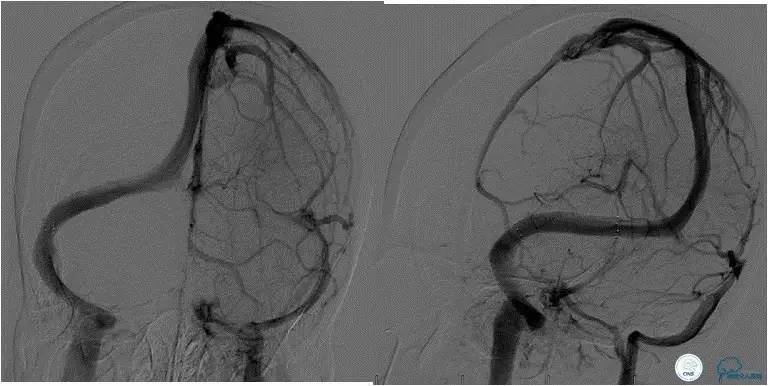 脑静脉窦狭窄放支架还能工作吗,颅内动脉支架植入术治疗血管狭窄