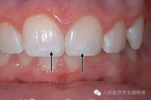 牙齿一块一块的白色氟斑牙怎么办,牙齿上的白点图片
