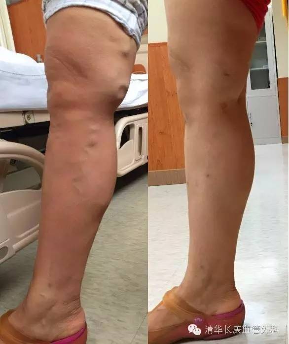 专家讲堂静脉曲张怎么治疗,静脉曲张微创射频闭合术