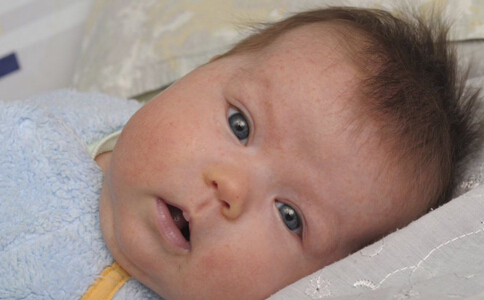 湿疹反复发作应注意四点,面部湿疹饮食要注意什么