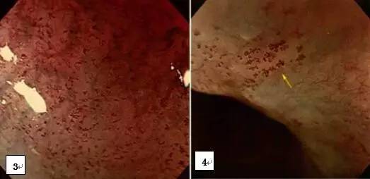 早期贲门癌内镜特征,内镜早癌