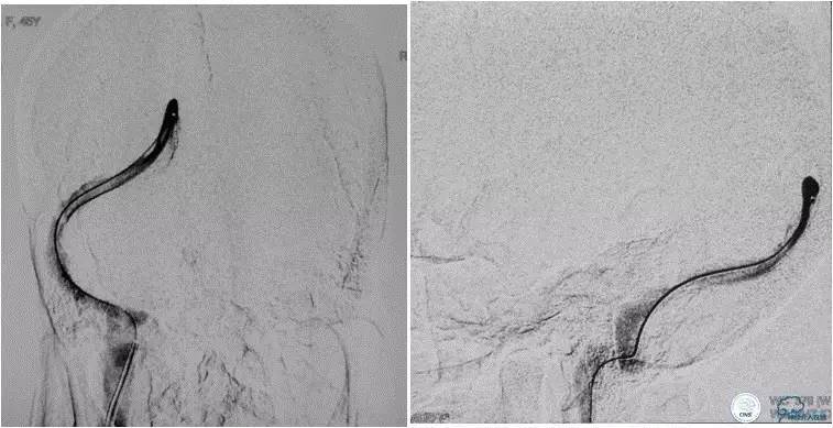 脑静脉窦狭窄放支架还能工作吗,颅内动脉支架植入术治疗血管狭窄