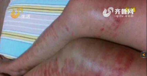青岛女子做激光脱毛变“斑马腿”大片红肿还起泡