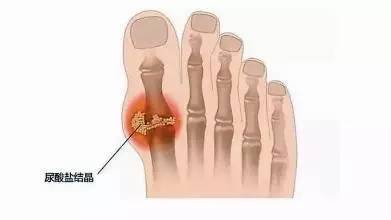 患痛风结石怎么办,痛风结石怎么治疗效果最好