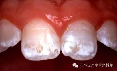 牙齿一块一块的白色氟斑牙怎么办,牙齿上的白点图片