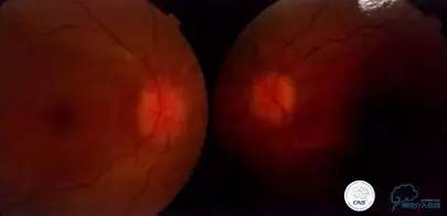 脑静脉窦狭窄放支架还能工作吗,颅内动脉支架植入术治疗血管狭窄