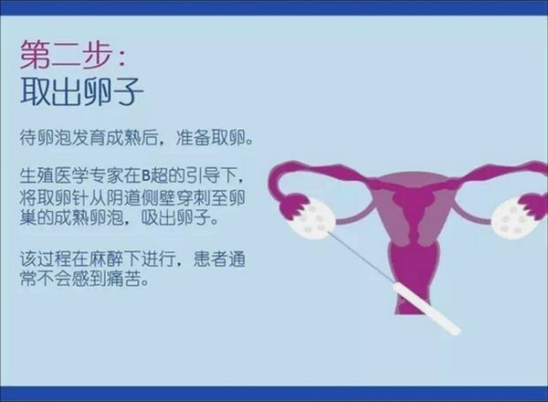 试管婴儿的正确方法及其流程,试管婴儿五种方法