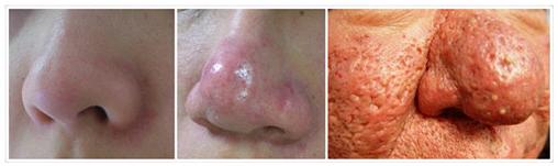 皮肤泛红有小疹子是怎么回事,皮肤泛红痒有小疙瘩