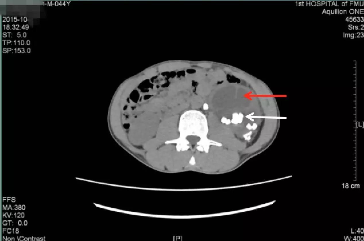 肾结石治疗最佳方案钬激光碎石,治疗肾结石案例