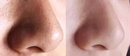 去草莓鼻最有效的产品,草莓鼻的有效解决方法
