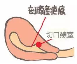 剖宫产的并发症护理措施,剖宫产术后的并发症发生原因