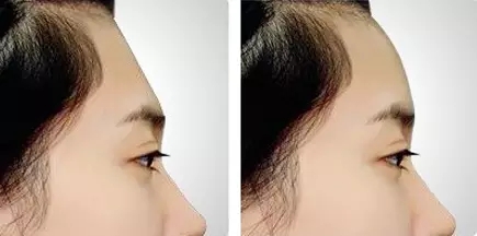 自体脂肪丰额头效果怎样,自体脂肪丰额头效果明显吗