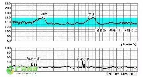 怀孕38周，肚里的娃突然没了胎心？！医生的话太吓人···